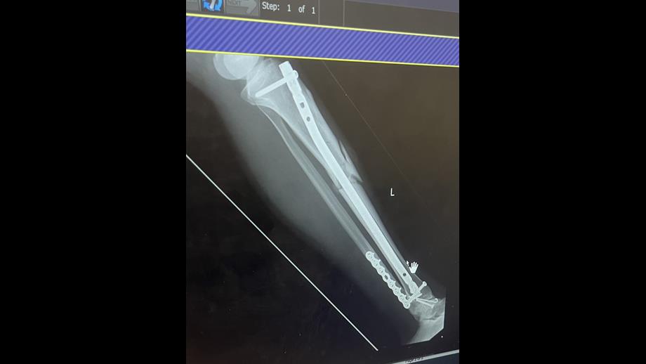 X-ray photo of Vicki's leg fracture showing a nail from her knee down to her ankle.